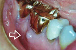 dental fistula photo
