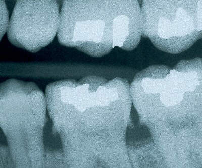 dental calculus x ray