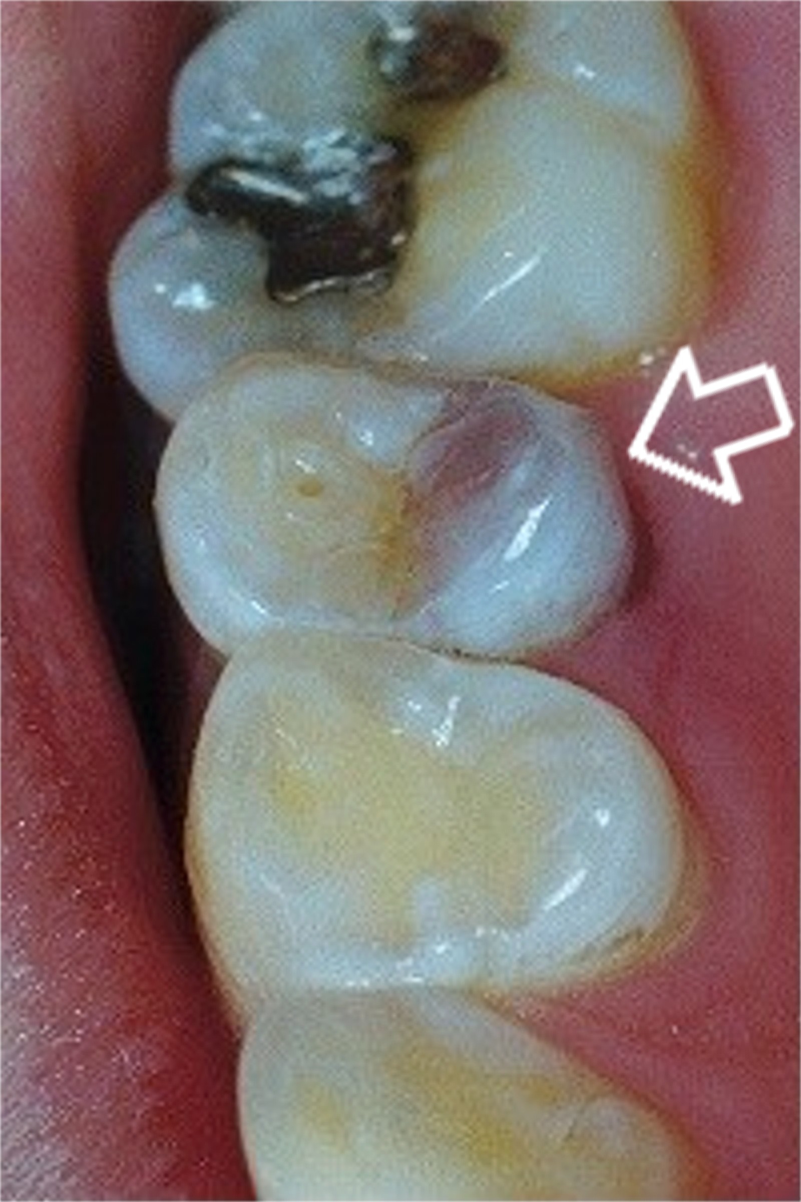 dental darkened tooth photo