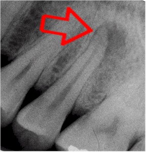 dental periapical xray