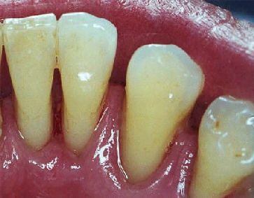seattle dentist plaque 2