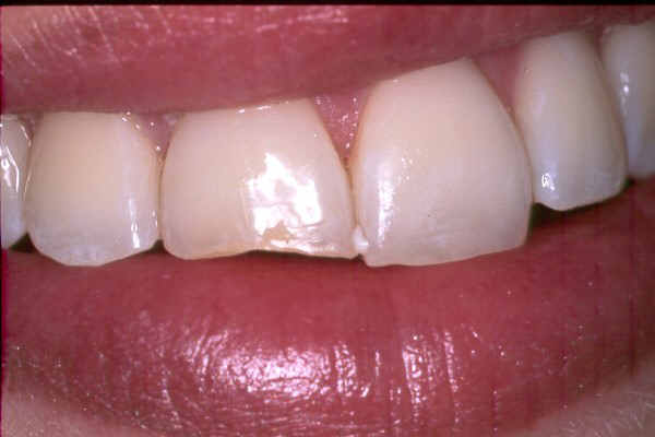Chipped Teeth Repair - dental photos of cosmetic fillings