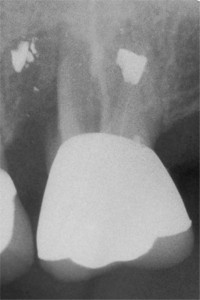 xray root resection 2.jpg (11935 bytes)